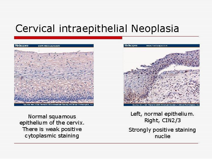 Cervical intraepithelial Neoplasia Normal squamous epithelium of the cervix. There is weak positive cytoplasmic