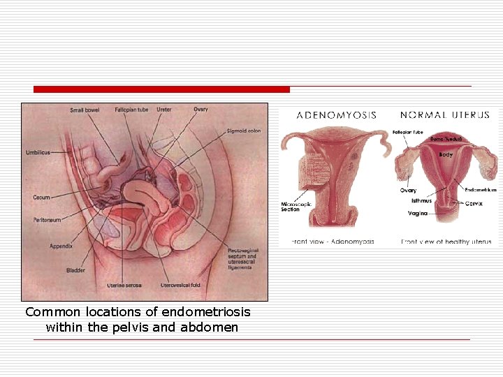 Common locations of endometriosis within the pelvis and abdomen 