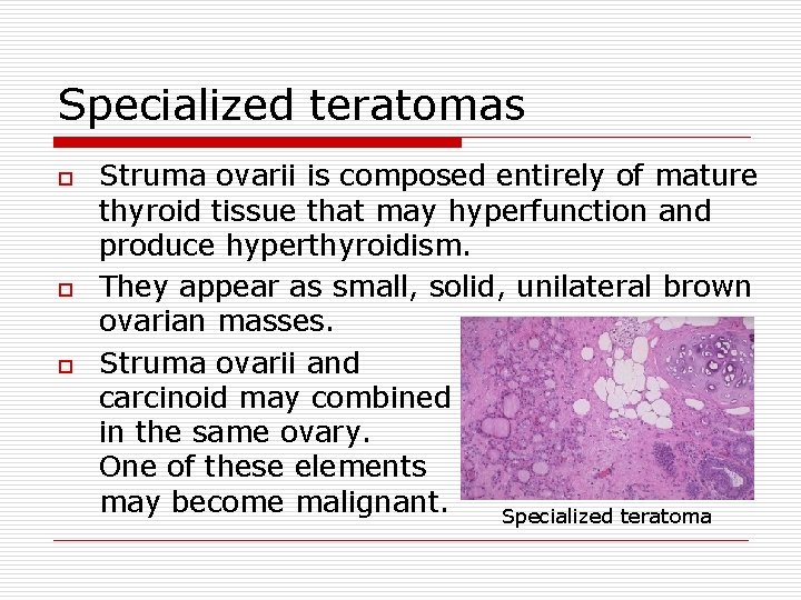 Specialized teratomas o o o Struma ovarii is composed entirely of mature thyroid tissue
