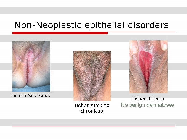 Non-Neoplastic epithelial disorders Lichen Sclerosus Lichen simplex chronicus Lichen Planus It’s benign dermatoses 