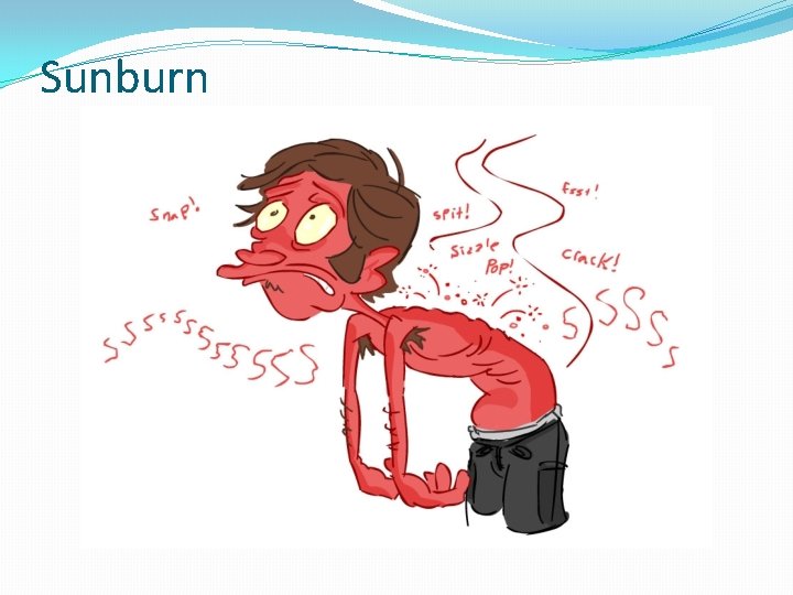 Sunburn 
