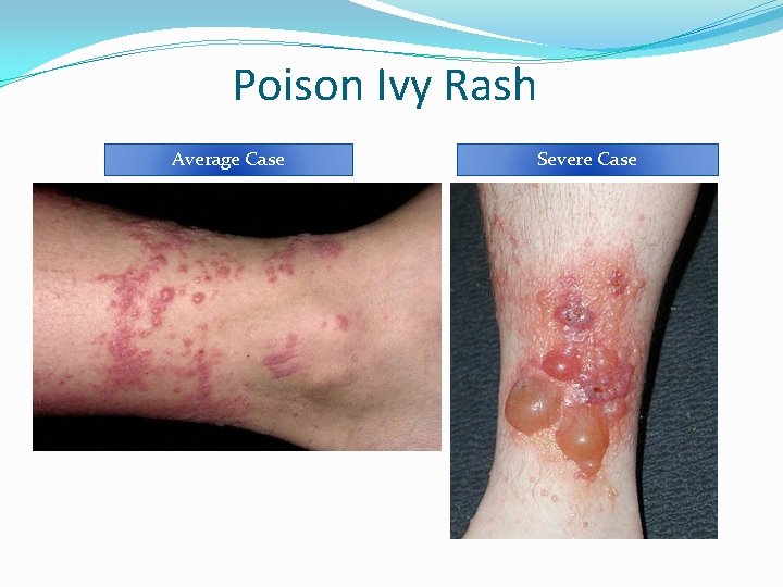 Poison Ivy Rash Average Case Severe Case 