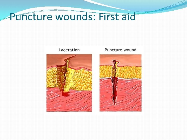 Puncture wounds: First aid 