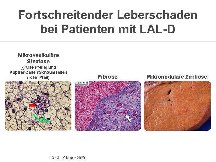 Fortschreitender Leberschaden bei Patienten mit LAL-D Mikrovesikuläre Steatose (grüne Pfeile) und Kupffer-Zellen/Schaumzellen (roter Pfeil)