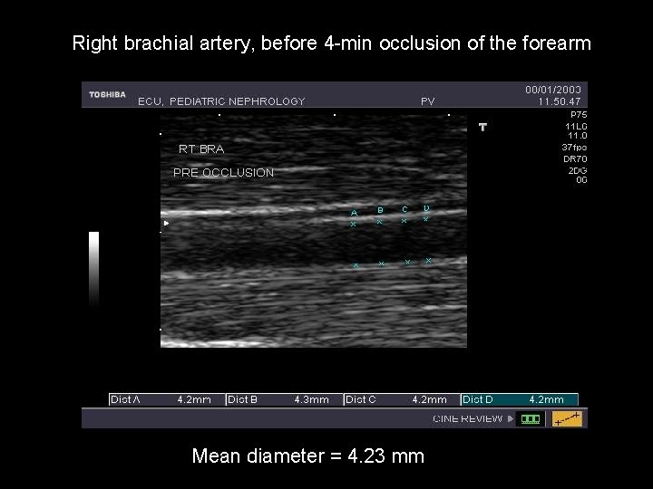 Right brachial artery, before 4 -min occlusion of the forearm Mean diameter = 4.