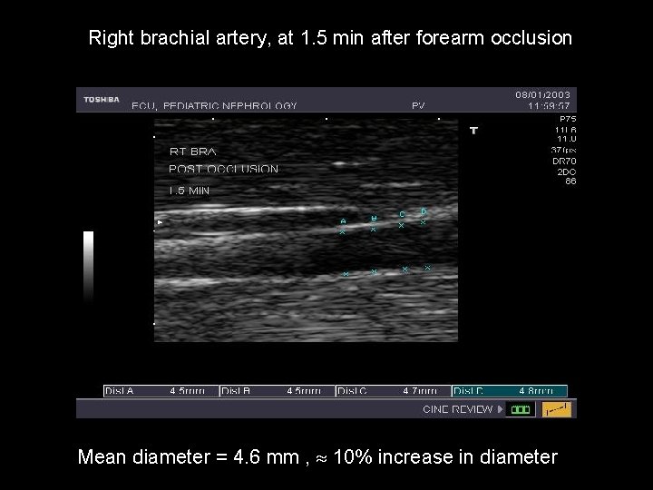Right brachial artery, at 1. 5 min after forearm occlusion Mean diameter = 4.