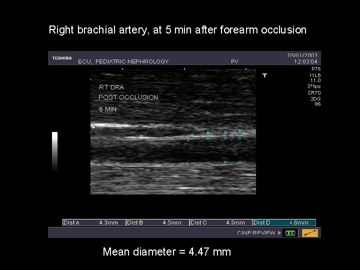 Right brachial artery, at 5 min after forearm occlusion Mean diameter = 4. 47