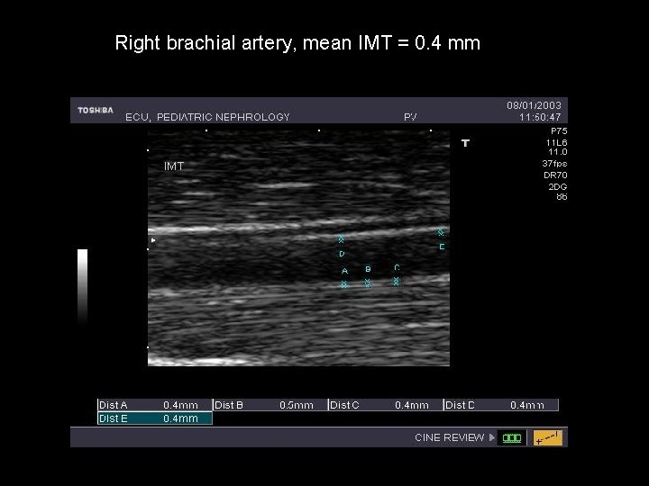 Right brachial artery, mean IMT = 0. 4 mm 