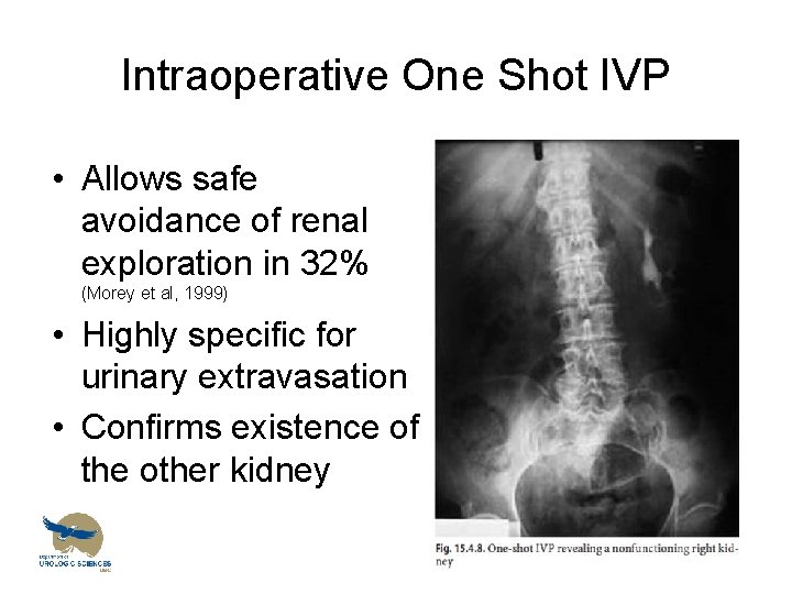 Intraoperative One Shot IVP • Allows safe avoidance of renal exploration in 32% (Morey