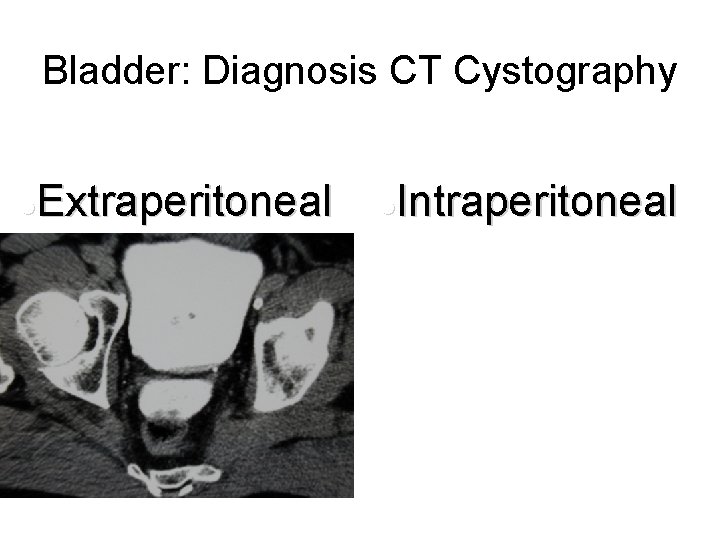 Bladder: Diagnosis CT Cystography Extraperitoneal l Intraperitoneal l 