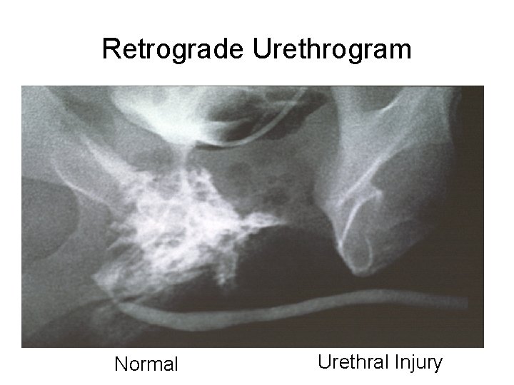 Retrograde Urethrogram Normal Urethral Injury 