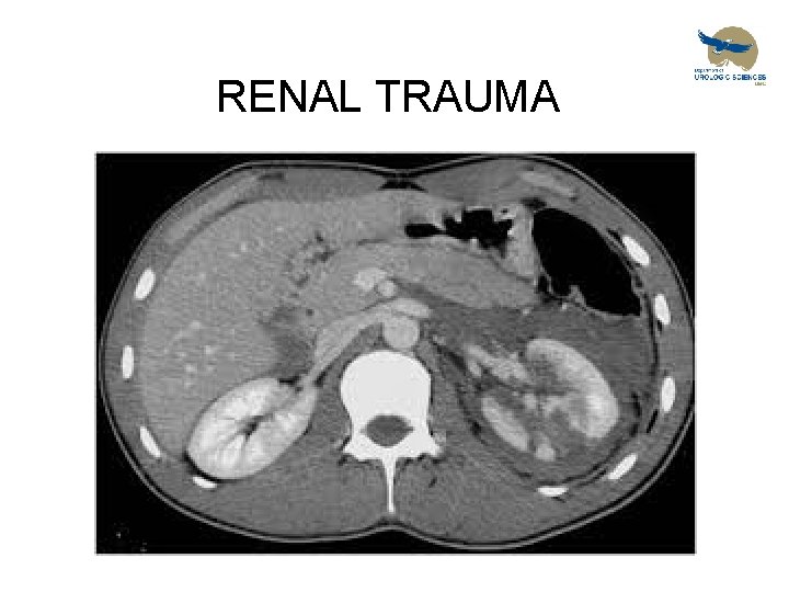 RENAL TRAUMA 