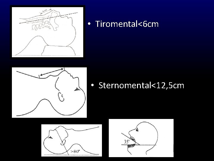  • Tiromental<6 cm • Sternomental<12, 5 cm 
