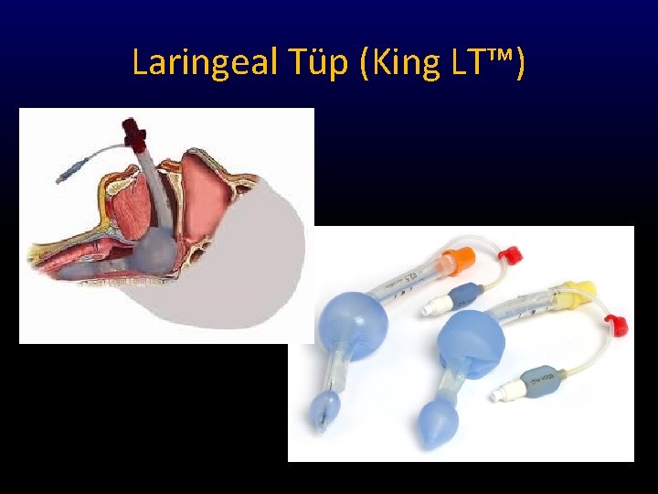 Laringeal Tüp (King LT™) 