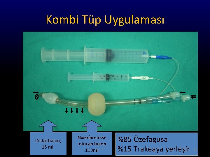 Kombi Tüp Uygulaması Distal balon, 15 ml Nasofarenkse oturan balon 100 ml %85 Özefagusa