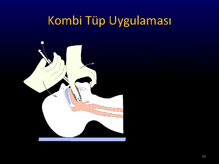 Kombi Tüp Uygulaması Dilin üzerinden ilerletin 54 