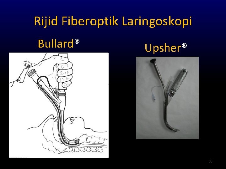 Rijid Fiberoptik Laringoskopi Bullard® Upsher® 60 
