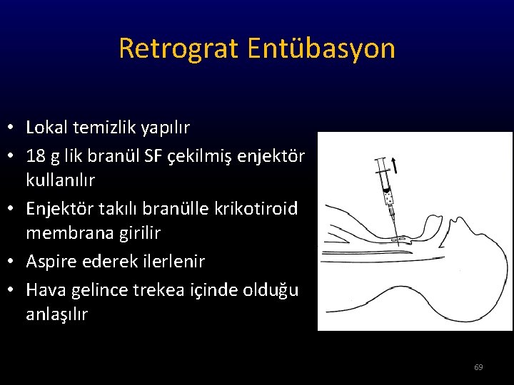 Retrograt Entübasyon • Lokal temizlik yapılır • 18 g lik branül SF çekilmiş enjektör