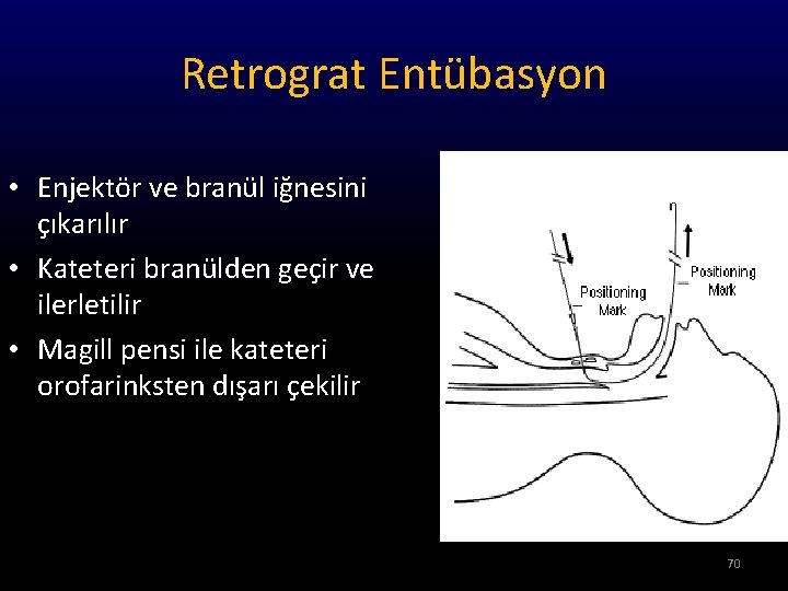 Retrograt Entübasyon • Enjektör ve branül iğnesini çıkarılır • Kateteri branülden geçir ve ilerletilir