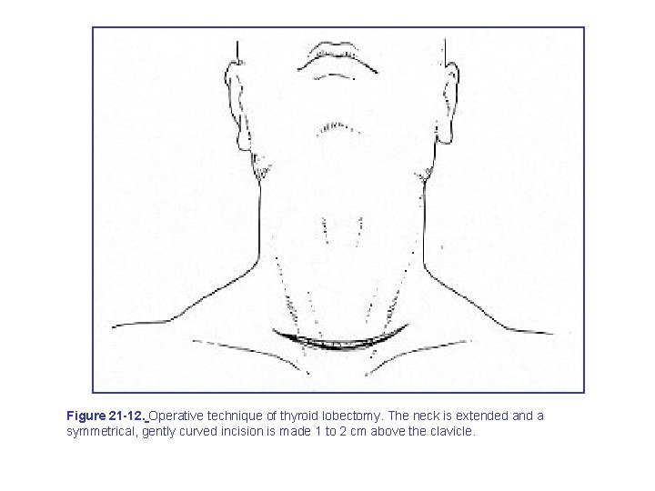 Figure 21 -12. Operative technique of thyroid lobectomy. The neck is extended and a