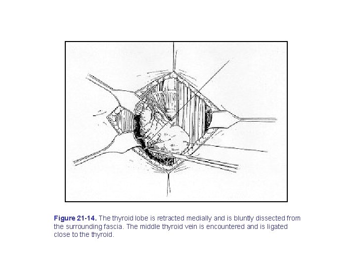 Figure 21 -14. The thyroid lobe is retracted medially and is bluntly dissected from