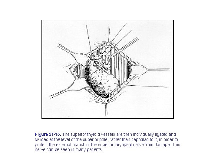 Figure 21 -15. The superior thyroid vessels are then individually ligated and divided at