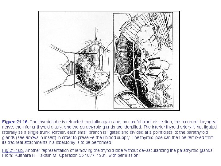 Figure 21 -16. The thyroid lobe is retracted medially again and, by careful blunt