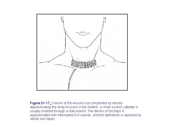 Figure 21 -17. Closure of the wound is accomplished by loosely approximating the strap