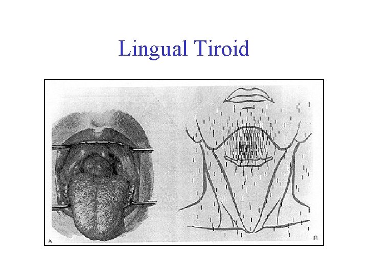 Lingual Tiroid 