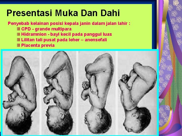 Presentasi Muka Dan Dahi Penyebab kelainan posisi kepala janin dalam jalan lahir : CPD