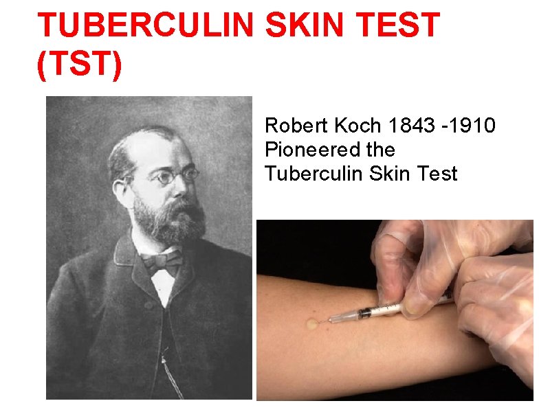21 TUBERCULIN SKIN TEST (TST) Robert Koch 1843 -1910 Pioneered the Tuberculin Skin Test