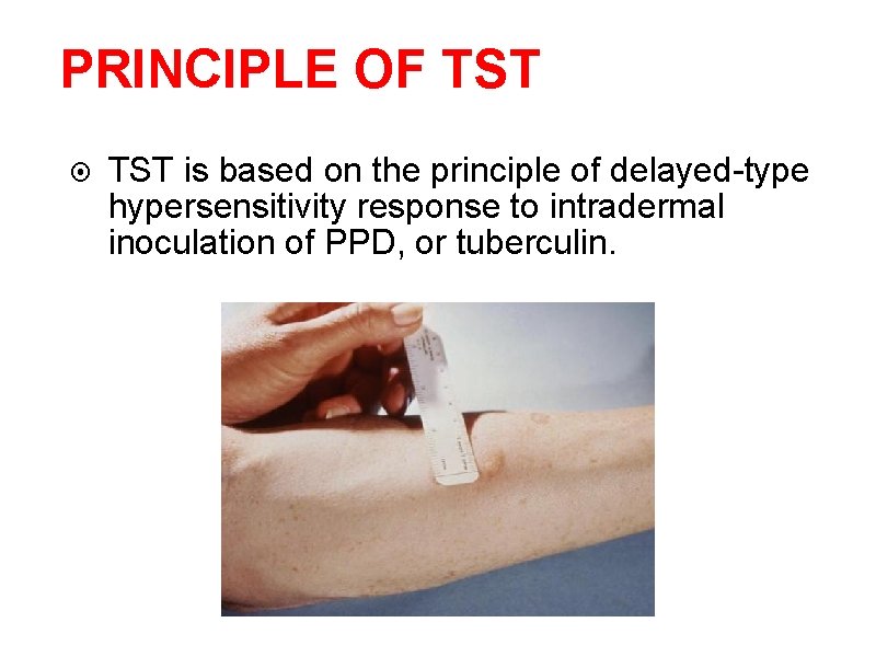 PRINCIPLE OF TST 22 TST is based on the principle of delayed-type hypersensitivity response