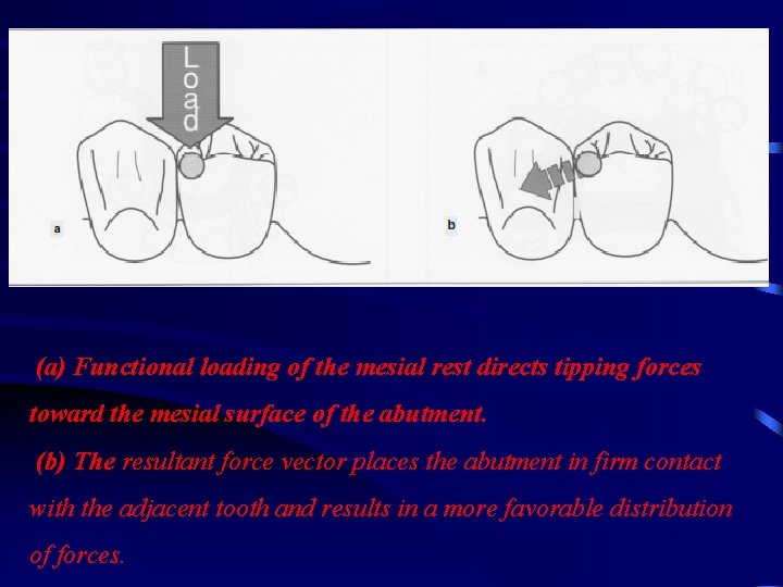 (a) Functional loading of the mesial rest directs tipping forces toward the mesial surface