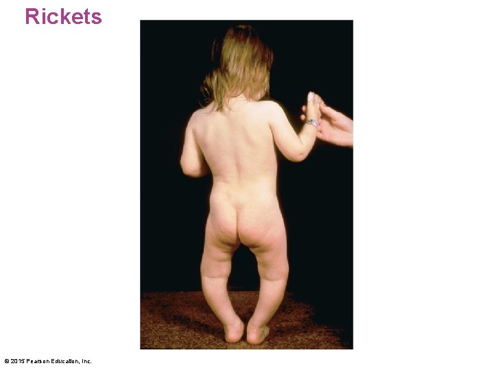 Rickets © 2015 Pearson Education, Inc. 