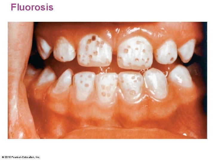 Fluorosis © 2015 Pearson Education, Inc. 