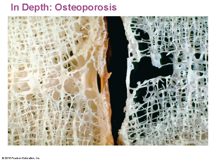 In Depth: Osteoporosis © 2015 Pearson Education, Inc. 