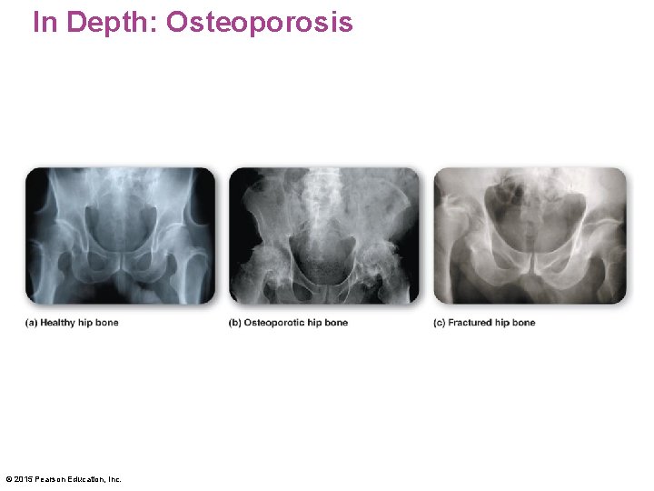 In Depth: Osteoporosis © 2015 Pearson Education, Inc. 