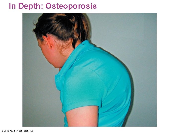 In Depth: Osteoporosis <insert In. Depth 9. 5 Figure 3 here> © 2015 Pearson