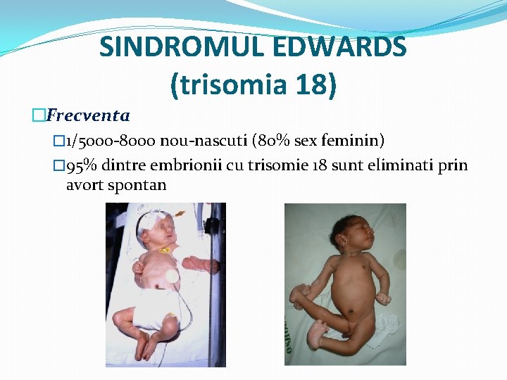 SINDROMUL EDWARDS (trisomia 18) �Frecventa � 1/5000 -8000 nou-nascuti (80% sex feminin) � 95%