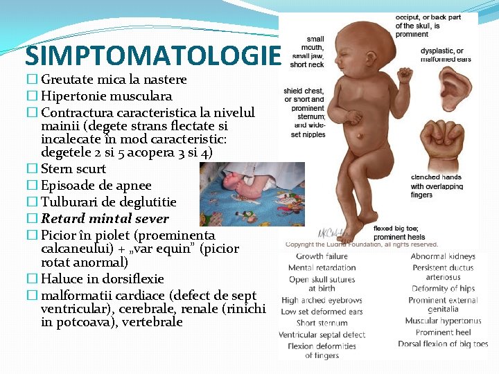 SIMPTOMATOLOGIE � Greutate mica la nastere � Hipertonie musculara � Contractura caracteristica la nivelul