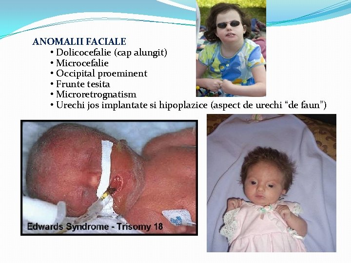 ANOMALII FACIALE • Dolicocefalie (cap alungit) • Microcefalie • Occipital proeminent • Frunte tesita