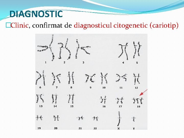 DIAGNOSTIC �Clinic, confirmat de diagnosticul citogenetic (cariotip) 