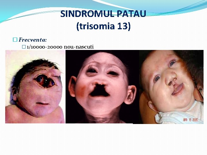 SINDROMUL PATAU (trisomia 13) � Frecventa: � 1/10000 -20000 nou-nascuti 