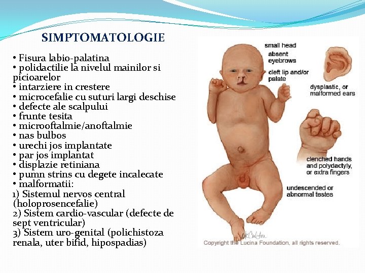 SIMPTOMATOLOGIE • Fisura labio-palatina • polidactilie la nivelul mainilor si picioarelor • intarziere in