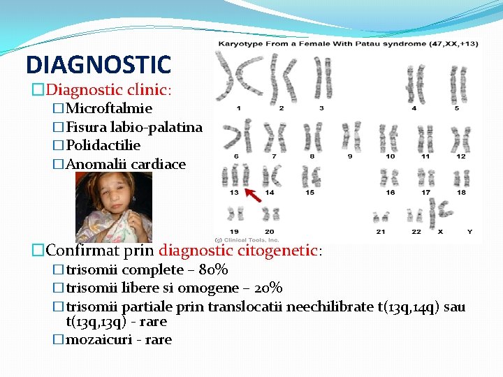 DIAGNOSTIC �Diagnostic clinic: �Microftalmie �Fisura labio-palatina �Polidactilie �Anomalii cardiace �Confirmat prin diagnostic citogenetic: �trisomii