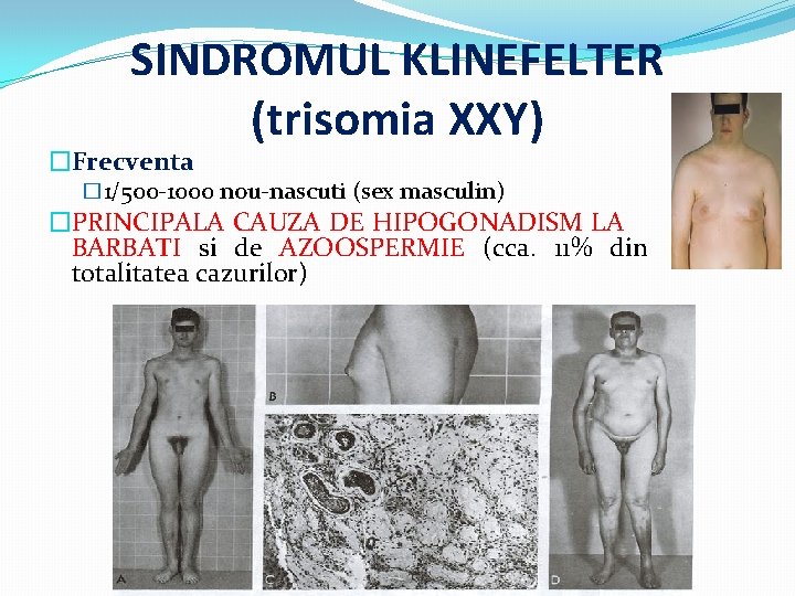 SINDROMUL KLINEFELTER (trisomia XXY) �Frecventa � 1/500 -1000 nou-nascuti (sex masculin) �PRINCIPALA CAUZA DE