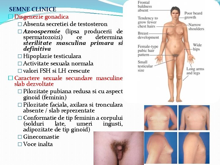 SEMNE CLINICE � Disgenezie gonadica � Absenta secretiei de testosteron � Azoospermie (lipsa producerii