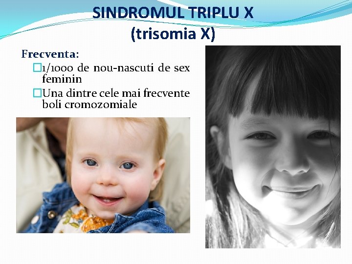 SINDROMUL TRIPLU X (trisomia X) Frecventa: � 1/1000 de nou-nascuti de sex feminin �Una