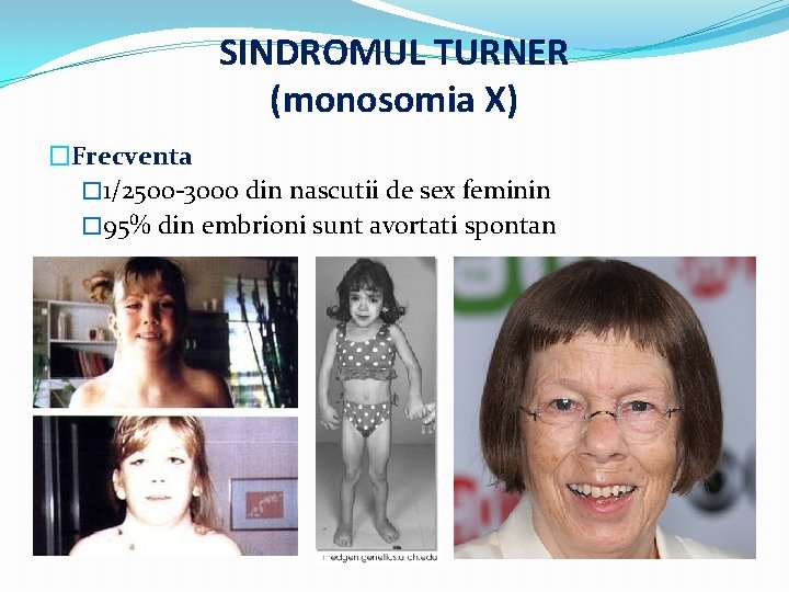 SINDROMUL TURNER (monosomia X) �Frecventa � 1/2500 -3000 din nascutii de sex feminin �