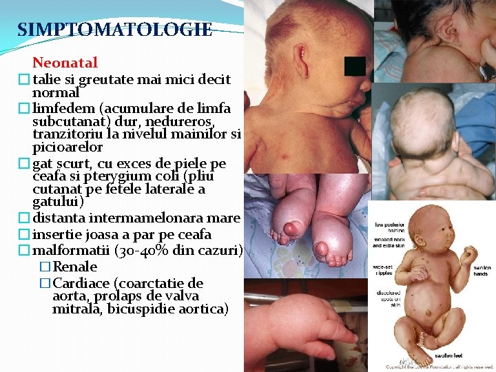 SIMPTOMATOLOGIE Neonatal �talie si greutate mai mici decit normal �limfedem (acumulare de limfa subcutanat)
